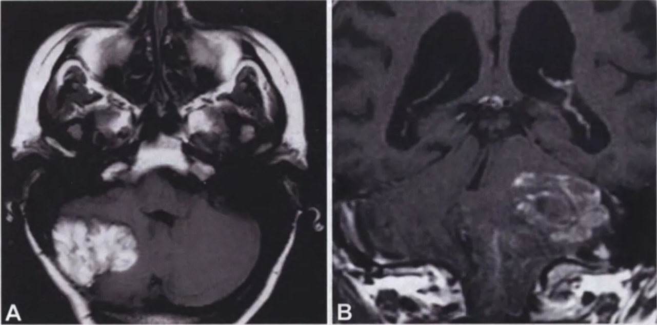 Fig. 6.47 Cerebellar liponeurocytoma. A Tl -weighted MRI (with gadolinium) of a recurrent liponeurocytoma, presenting as an irregular, strongly enhancing lesion in the right cerebellar hemisphere. Reprinted from Jenkinson MD et al. {1153}. B Axial T I-weighted MRI after gadolinium administration shows areas of prominent hypointense signal within a well- demarcated isodense tumour {53}. 