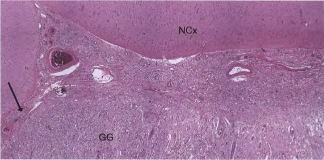 .N.cx Fig. 8.13 Gangli"loma (GG) with sharp demarcation fram the adjacent brain parenchyma (NCx) and infiltration into subarachnoid space (arrcrw). 