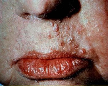 Multiple trichilemmomas in patient with Cowden dis