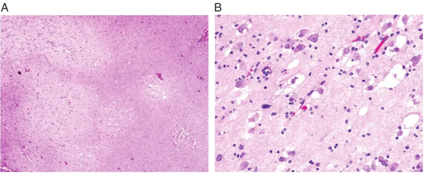 Fig. 4 Multinodular and vacuolating neuronal tumor is a benign tumor comprising monomorphous neuronal elements in discrete and coalescent nodules, with vacuolar changes both in tumor cells and the neuropil. (A) Multinodular appearance (H&E, x40). (B) Vacuolar change in tumor cells and in neuropil (H&E, x200). 