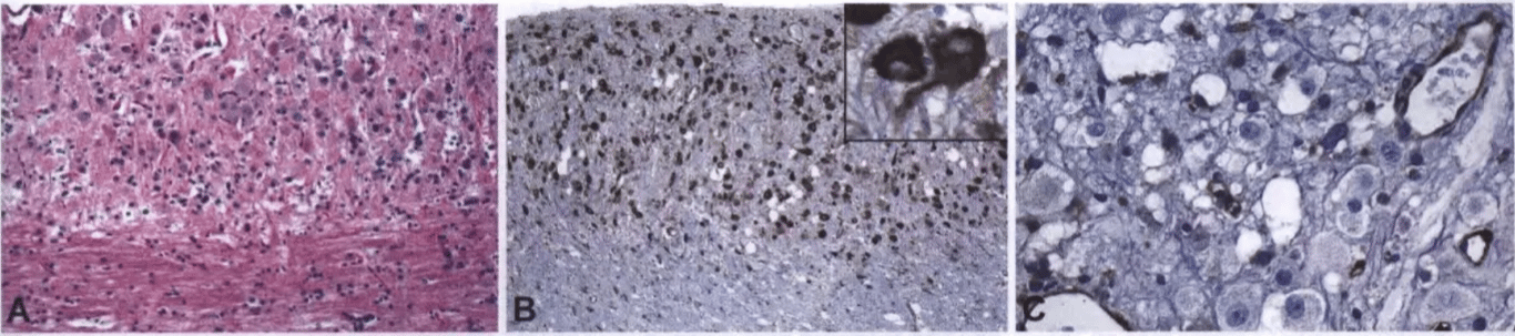 Fig. 6.20 Dysplastic cerebellar gangliocytoma. A The internal granule layer of the cerebellum at the top of the image is filled with dysplastic ganglion cells. B The dysplastic ganglion cells are strongly immunopositive for phosphorylated S6. C Immunohistochemical stains for P TEN show loss of eypression in the enlarged neurons, with preserved staining in vessels. 