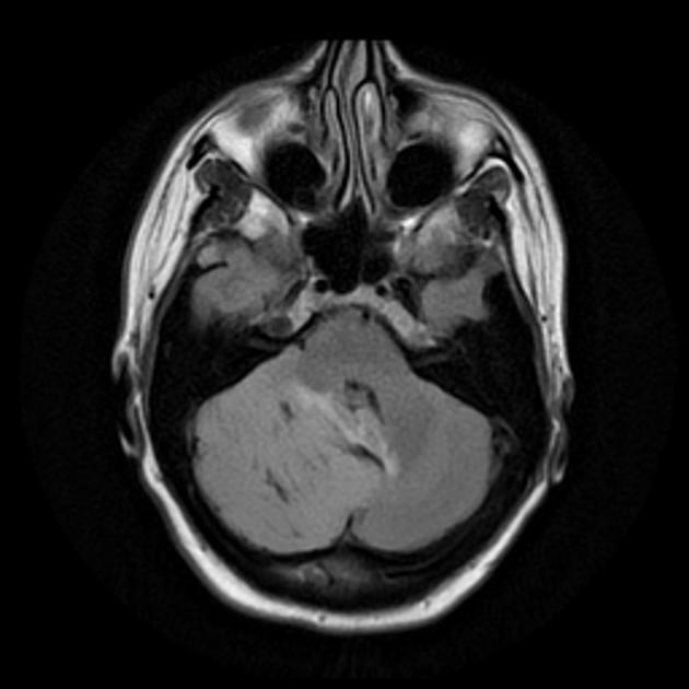 A mri of a brain AI-generated content may be incorrect.