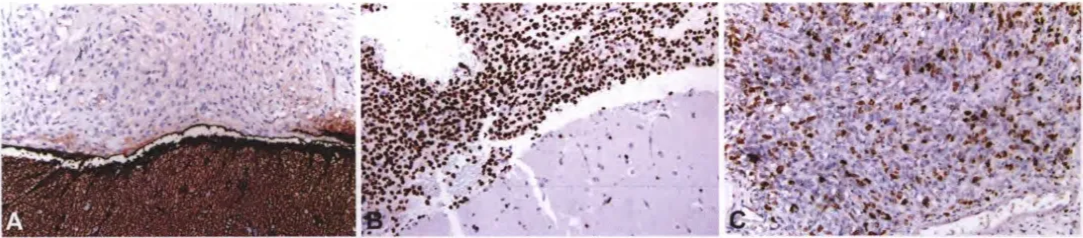 Fig. 6.36 Diffuse leptomeningeal glioneuronal tumour. A The tumour cells are GFAP-negative. B Tumour cells show extensive nuclear immunoreactivity for OLIG2. C Diffuse leptomeningeal glioneuronal tumourwith anaplastic features. The Ki-67 proliferation index is elevated, suggestive of a more aggressive clinical behaviour. 