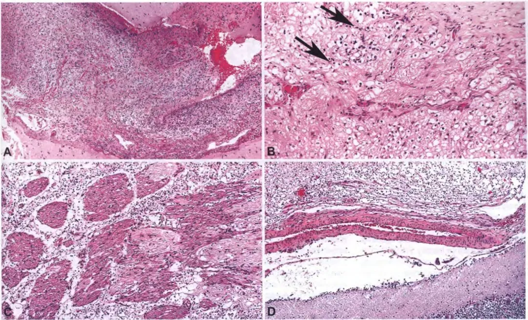 Fig. 6.35 Diffuse leptomeningeal glioneuronal tumour. A Marked expansion and hypercellularity of the leptomeninges. B A small intraparenchymal component may be present, usually in the spinal cord. Infiltration of overlying leptomeninges by neoplastic cells (arrows) is typical. C Extensive leptomeningeal dissemination in spinal cord may result in intimate coating of nerve roots. D Cerebellar leptomeninges. Infiltration by bland oligodendroglial-like cells throughout the CNS is a key histological feature. 