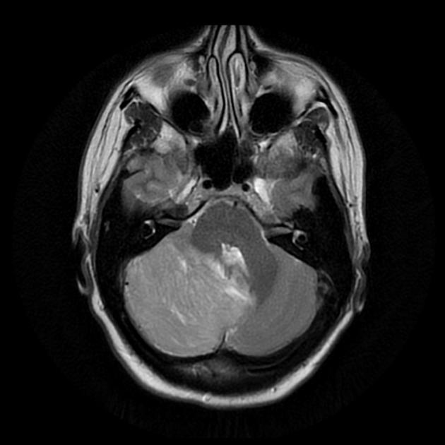 A mri of a brain AI-generated content may be incorrect.