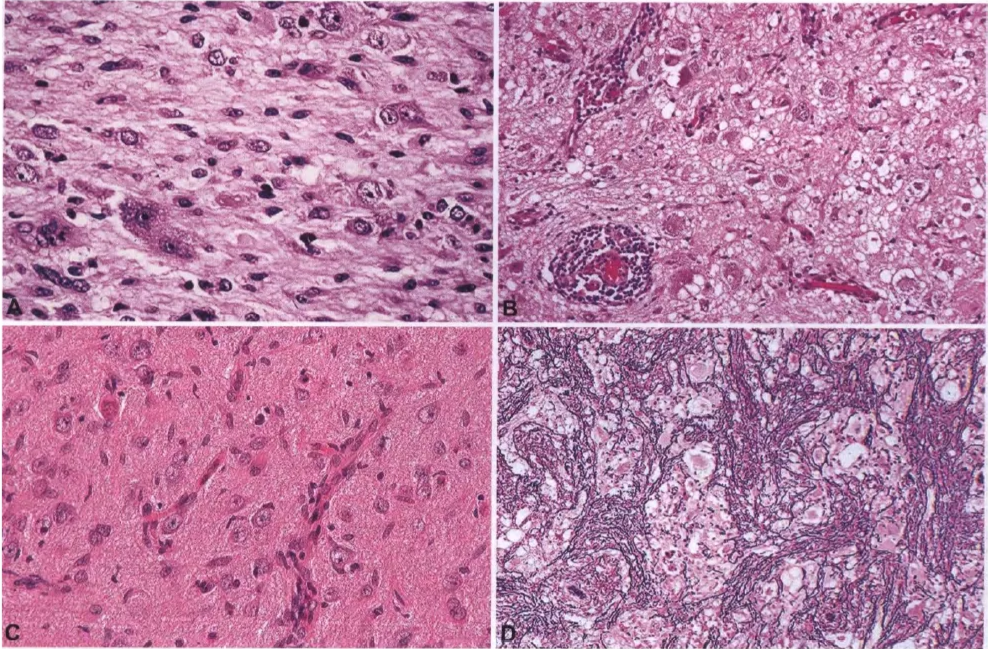 Fig. 6.14 Ganglioglioma_ A Shmvlng the typical biphasic pattem of Irregularty oriented, dysplastic, and occasionally binucleated neurons and neoplastic glial cells. B Prominent dysplastic neuronal component and pehvascular inflammatory exudates. C Biphasic ccmposition of dysplastic neurons and neoplastc glial cells. O Occasionalty, gangliogliamas develop a reticulin fibre network apan from the vasculature. 