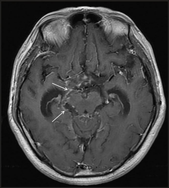 A close-up of a brain mri AI-generated content may be incorrect.
