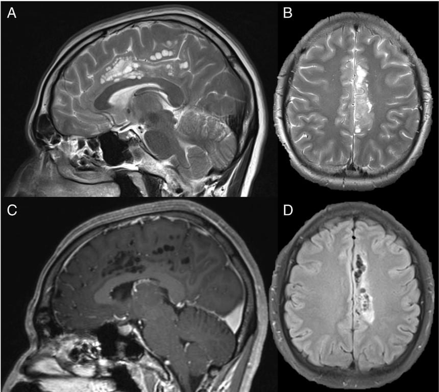 A close-up of a brain scan AI-generated content may be incorrect.