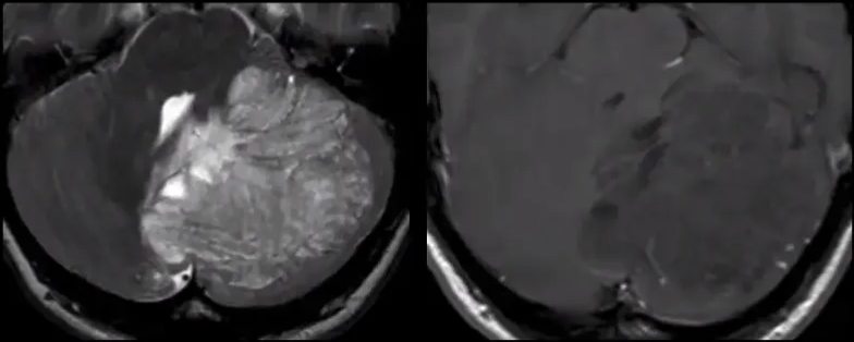 PTEN HAMARTOMA TUMOR SYNDROME AD cancer-predisposition syndrome • COWDEN SYNDROME : multiple hamartoma syndrome, benign and malignant tumors of the thyroid, breast, and endometrium • BANNAYAN-RILEY-RUVALCABA SYNDROME: macrocephaly, intestinal hamartomatous polyposis, lipomas, and pigmented macules of the glans penis • PTEN-RELATED PROTEUS SYNDROME and PROTEUS-LIKE SYNDROME 4 DYSPLASTIC GANGLIOCYTOMA OF THE CEREBELLUM LHERMIHE-DUCLOS DISEASE Bosemani et Al Neuroimag Clin N Am 2016 