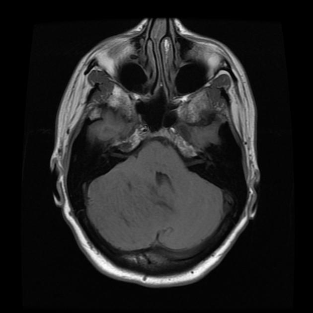 A mri of a brain AI-generated content may be incorrect.