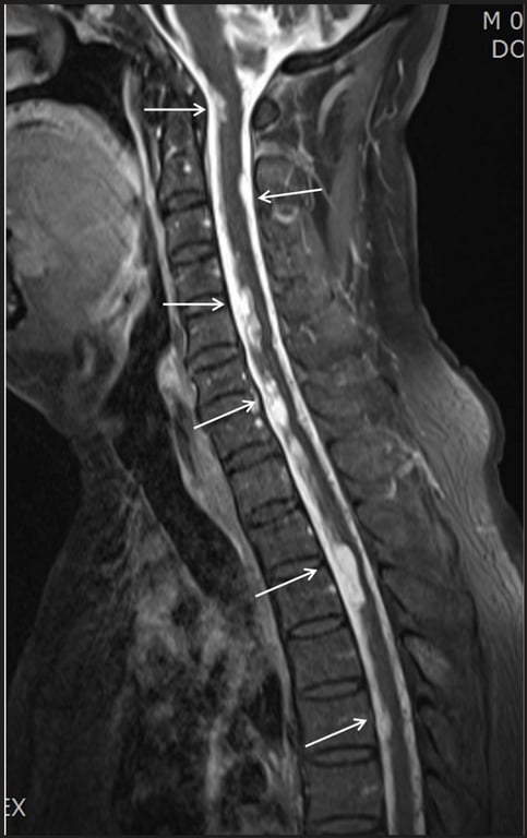 An x-ray of a spine AI-generated content may be incorrect.