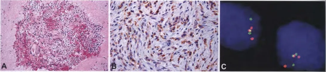 Fig. 6.37 Diffuse leptomeningeal glioneuronal tumour. A Extension along the perivascular Virchow-Robin space is evident within the adjacent brain parenchyma of this tumour. B Synaptophysin positivity is seen in this tumour. C FISH studies using BRAF (red) and KIAA 1549 (green) probes show increased copy numbers and yellow fusion signals. 