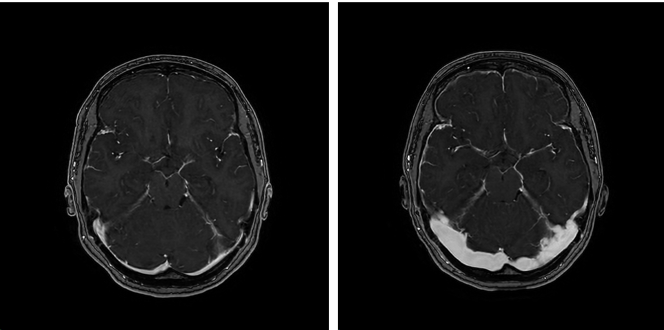 FSPGR sequences demonstrating bilateral transverse sinus stenosis before (LEFT) and after (RIGHT) VP shunting