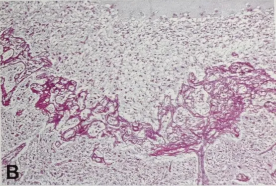Fig. 1.36 A Longitudinal cut of perinecrotic palisades, presenting as long, serpiginous pattern. B Reticulin stain of perinecrotic garland of proliferated tumour vessels. 