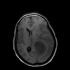 A mri of a brain AI-generated content may be incorrect.