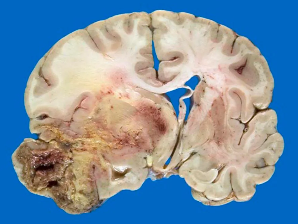 A close-up of a brain AI-generated content may be incorrect.