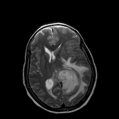 A mri of a brain AI-generated content may be incorrect.