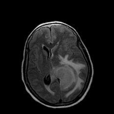 A mri scan of a brain AI-generated content may be incorrect.