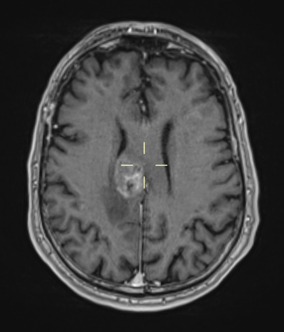 A close-up of a brain scan AI-generated content may be incorrect.