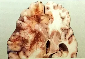 Fig. 1.40 Giant cell glioblastoma. The cut surface shows a multinodular lesion with necrosis and haemosiderin deposits. 
