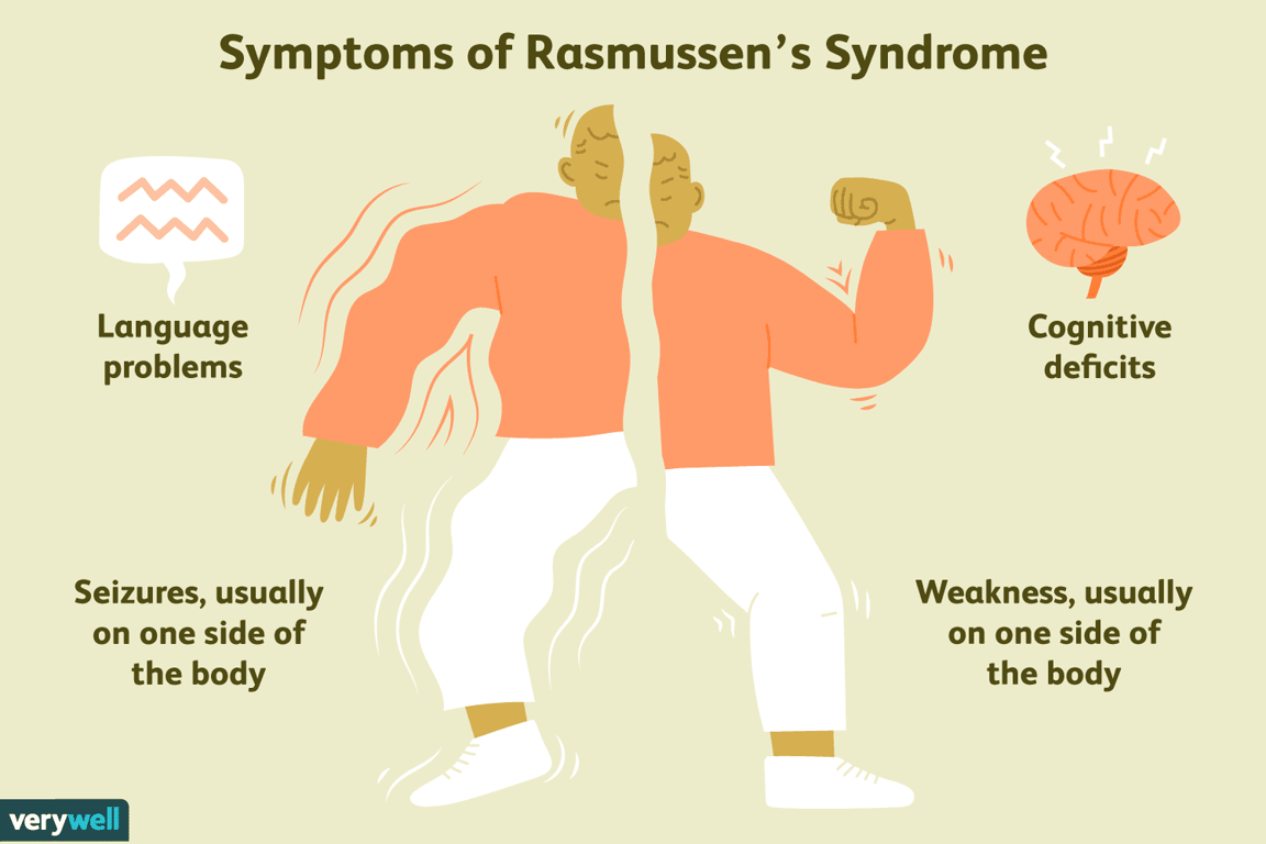 Rasmussen's Encephalitis