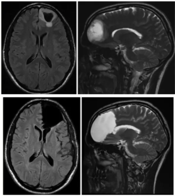 Sec ed*vial in this . I J Neur«urg IIS:2W239. Awake surgery for WHO Grade Il gliomas within "noneloquent" areas in the left dominant hemisphere: toward a "supratotal" resection Clinical article N. YORO'NOVA. M.D„• SYLVIE Mourn-GA.s,sv.g, AND M.D.. of Neumsurgery. H"piral Gui de Ch'wliac. CHU Centra Nenous S' Stem. Stem Cell' and Glial - INSERM U' IOS I. Ins rind Of Neurosciences Of MOMpetlier. Höp•td Saint Montpellier. France Acu (2016' I SS Si-SS 10 ARTICU - BRAIN TUMORS Long-term outcomes after supratotal resection of diffuse low-grade gliomas: a consecutive series with I I-year follow-up 