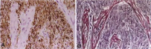 Fig. 1.45 Gliosarcoma. Biphasic pattern. Serial sections showing an alternating pattern of (A) GFAP-expressing glioma tissue and (B) sarcomatous areas that contain reticulin fibres but lack GFAP. 