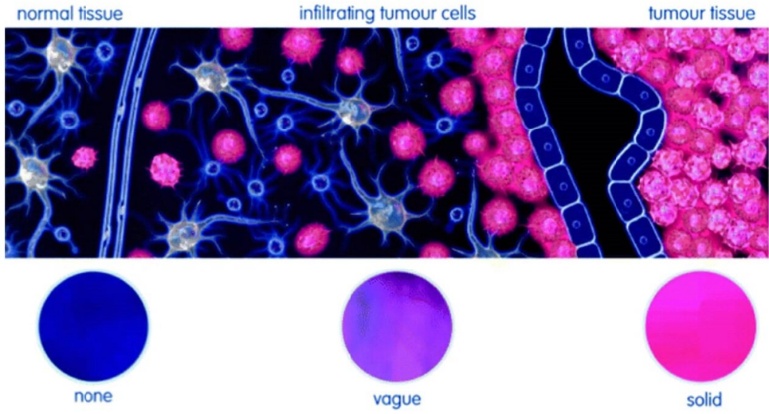 normal tissue infiltrating tumour cells tumour tissue vague 