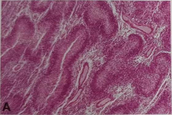 Fig. 1.36 A Longitudinal cut of perinecrotic palisades, presenting as long, serpiginous pattern. B Reticulin stain of perinecrotic garland of proliferated tumour vessels. 