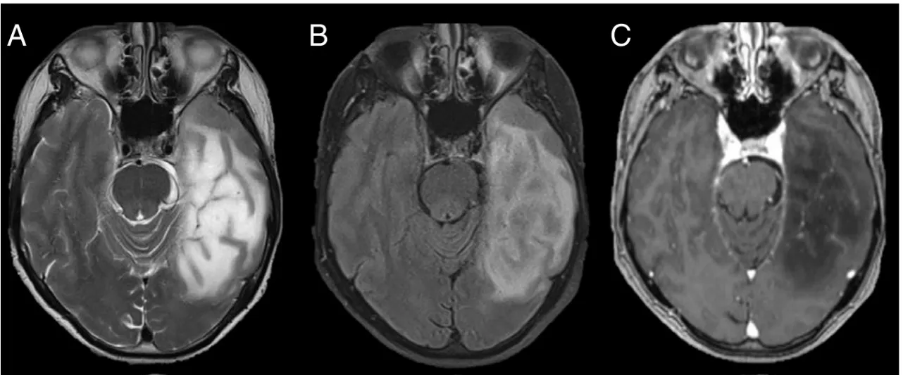 A close-up of a brain scan AI-generated content may be incorrect.