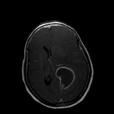 A mri scan of a brain AI-generated content may be incorrect.