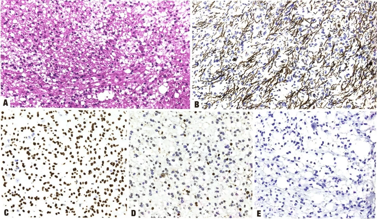 Diffuse midline glioma, H3 K27-altered. 
A, A pontine glioma showing infiltrative neoplastic cells in an oedematous background, with some residual neurons. 
B, The neurofilament stain highlights the diffusely infiltrative growth. 
C, Intense nuclear staining for H3 p.K28 (K27)-mutant protein, with internal negative controls in endothelial cells and neurons. 
D, Immunohistochemical staining for H3 p.K28me3 (K27me3) shows loss of expression in tumour cells, with retention in endothelial cells and residual neurons. 
E, Negativity for EZHIP immunostaining.