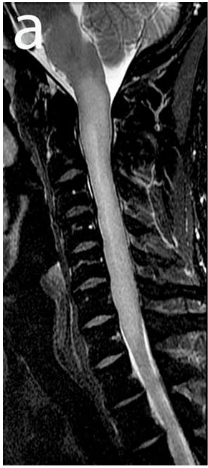 Spinal lesion is non-enhancing intramedullary mass with expansion and signal abnormalities on T2