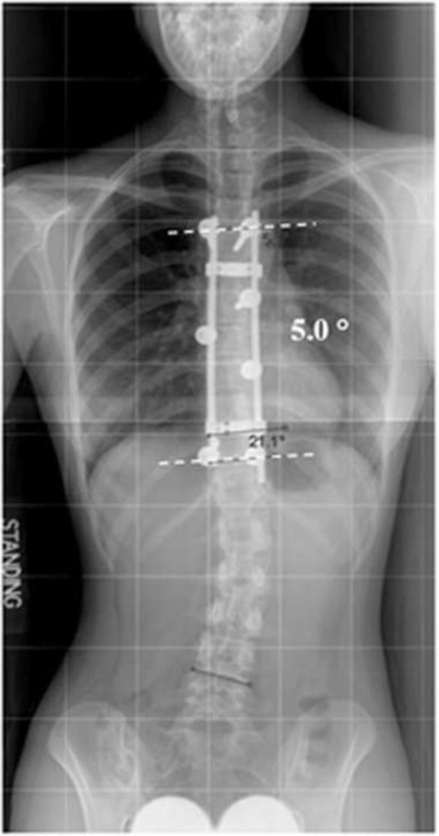 Immediate postoperative radiograph illustrated curve correction to 5.0 degrees. The curve correction rate was 90% and the FBCI was 110.8%.