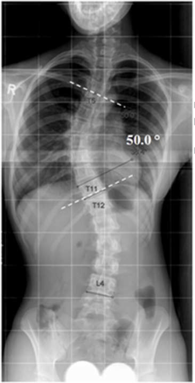 Standing coronal radiograph of a 12-year-old female patient with AIS and a main thoracic curve of 50.0 degrees from T5 to T11.