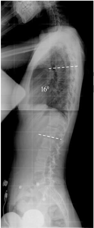 Standing sagittal alignment was 16 degrees from T5-T12.