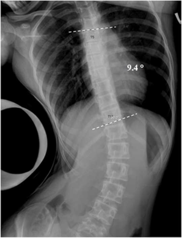 Fulcrum bending radiograph of the patient demonstrated correction of the thoracic curve to 9.4 degrees. The fulcrum bending flexibility was 81.2%.