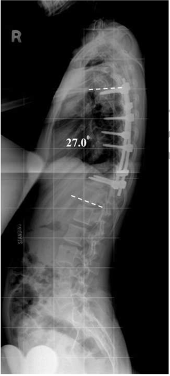 Immediate postoperative sagittal radiograph illustrating the sagittal alignment of the patient at 27.1 degrees, which was maintained on last follow-up.