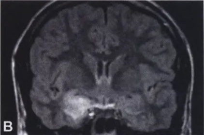 A close-up of a brain scan AI-generated content may be incorrect.