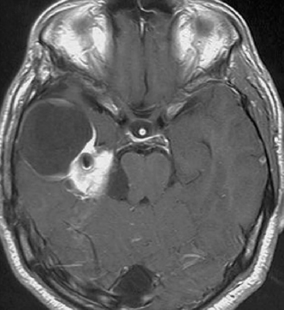 A close-up of a brain mri AI-generated content may be incorrect.