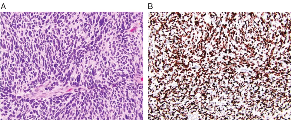 Fig. 2 Diffuse hemispheric glioma, H3 G34-mutant, is a malignant, infiltrative glioma, typically of the cerebral hemispheres and with a missense mutation in the H3F3A gene that results in a G34R/V substitution of histone H3. (A) High-grade anaplastic features, sometimes with an embryonal appearance (H&E, x200) and (B) positive nuclear staining with H3 G34R/V immunohistochemistry (x100). 
