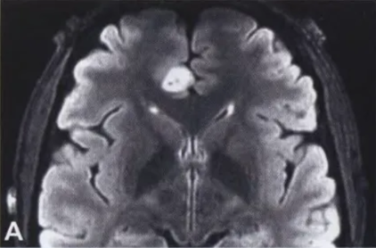 A close-up of a brain scan AI-generated content may be incorrect.