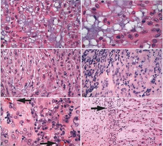 Fig. 4.03 Chordoid glicrna of the third ventricle. A Histologicaly, tLmours are characterized by cohesive clusters of epithelioid cells with abundant pink cytoplasm and a bubbly, bluish, mucin-rich stoma. B At higher magnifcatlon, nuclei are oval, mc&rate in size, and bland, and have dispersed chromatim Mitotc activity and nuclear atypia are absent. C In almost every Instance, tLmour cells also fom solid arrangements of either nests or linear arrays. Lymphoplasmacytic Infiltrate present in nearly all Chordoid gliomas, and Russell bodies can be identifed (E, anows). F The border between Chordoid gliama and adjacent brain is well defined, with litte evidence of tumour infiltration, often 'Mth chronic inflammation (arrcw) and Rosenthal fibres in the neighbouring brain. 
