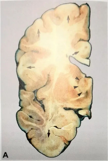 Fig. 2.16 Subependymal giant cell astrocytoma. A Coronal section of the left hemisphere of a patient with tuberous sclerosis, showing a subependymal giant cell astrocytoma (arrowheads) and multiple cortical tubers (arrows). B Multiple subependymal nodules on the walls of the lateral ventricles. 