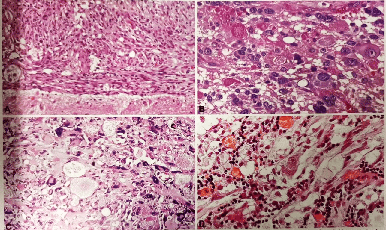 Fig. 2.22 Histologicai features of pleomorphicxanthoastrocytoma. A Leptomeningeal pleomorphic xanthoastrocytoma, sharply delineated from the underlying cerebral cortex. B Granular bodies, intensely eosinophilic or pale, are an almost invariable finding. C Tumour cells showing nuclear and cytoplasmic pleomorphism and xanthomatous change. D Mature ganglion cell and lymphocytic infiltrates; reprinted from Kros JM et al. {1375}. 