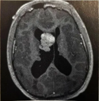 2.14 Subependymal giant cell astrocytom extending 