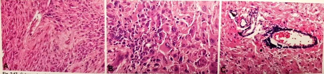 Fig. 2.17 Subependymal giant cell astrocytoma. A Cellular heterogeneity is typical for these tumours; elongated cells arranged within sweeping fascicles are admixed with large cells. B Infiltration of inflammatory cells, induding mature lymphocytes and mast cells, is a consistent feature. C Multifocal calcification within the tumour and/or blood vessels is commonly seen. 