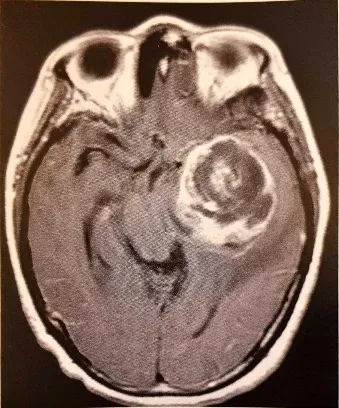 Fig. 2.25 Anaplastic pleomorphic xanthoastrocytoma. Tl -weighted MRI with contrast sequences demonstrates a large non-homogeneously enhancing tumour with mass effect and moderate surrounding oedema. 