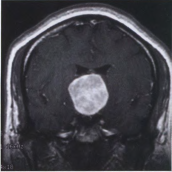 A close-up of a mri scan AI-generated content may be incorrect.