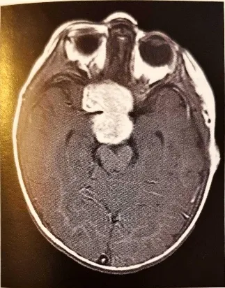 Fig. 2.11 Pilomyxoid astrocytomas are usually large, contrast-enhancing masses that are most frequent in the hypothalamic and suprasellar areas. 